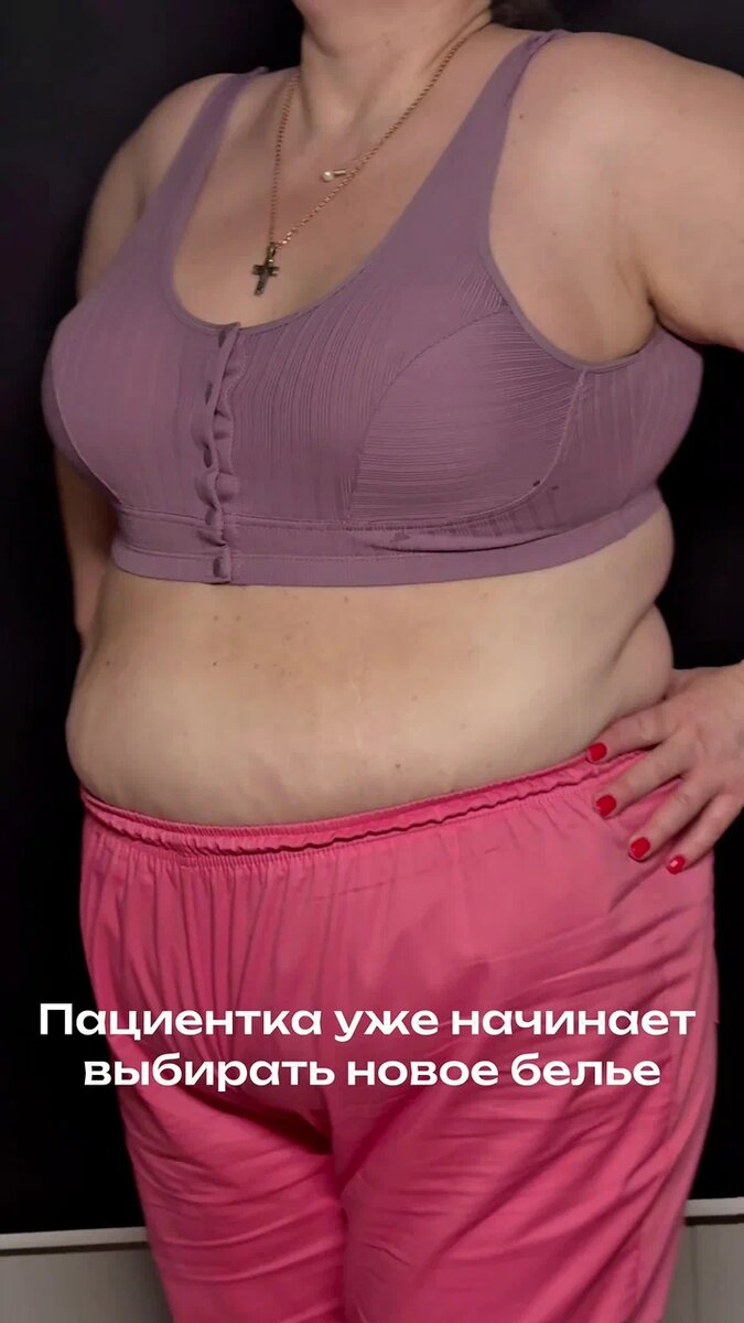 5 недель после уменьшения груди на 3.5 килограмма. 