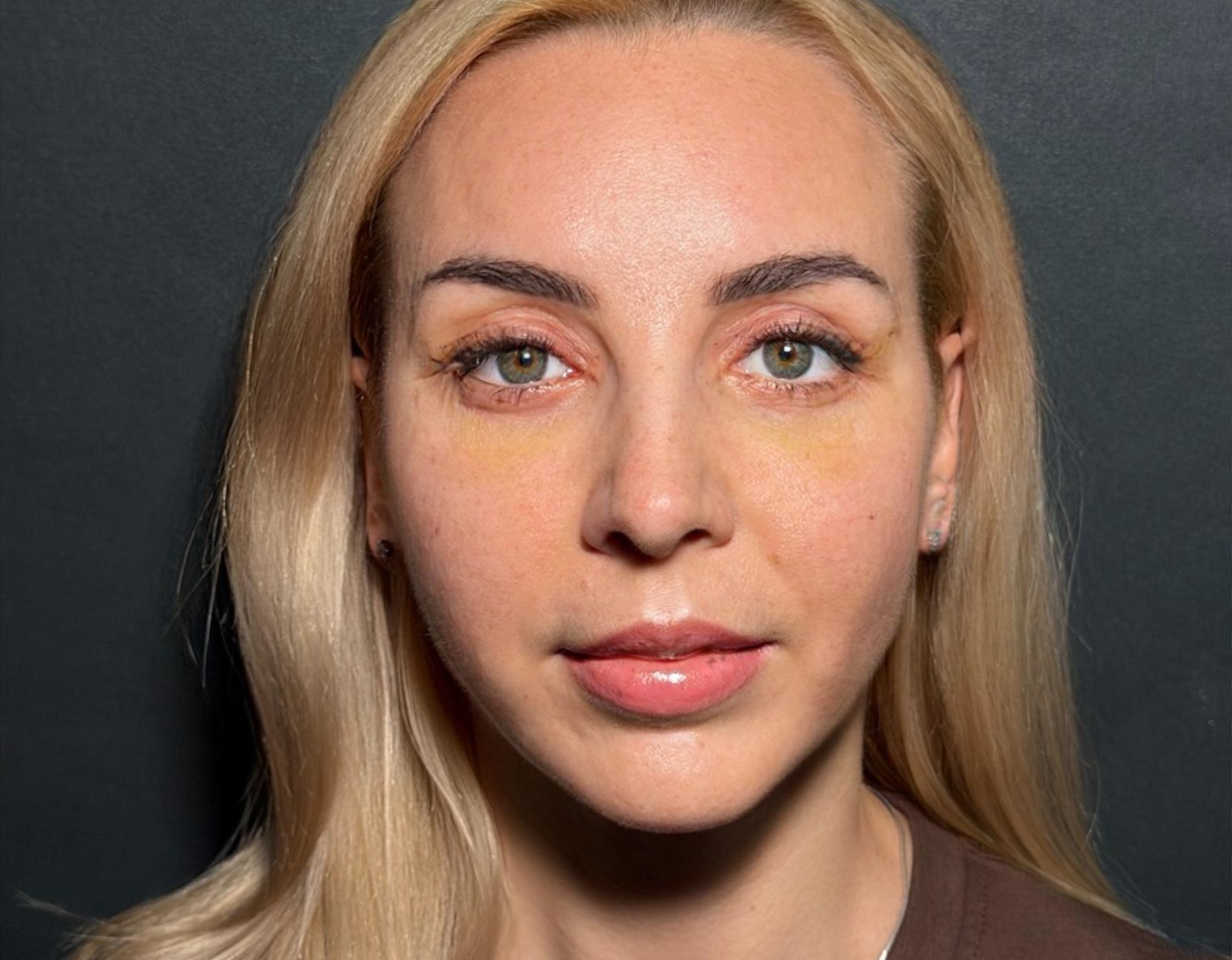 GLOW LIFT — инновационная методика омоложения средней зоны лица