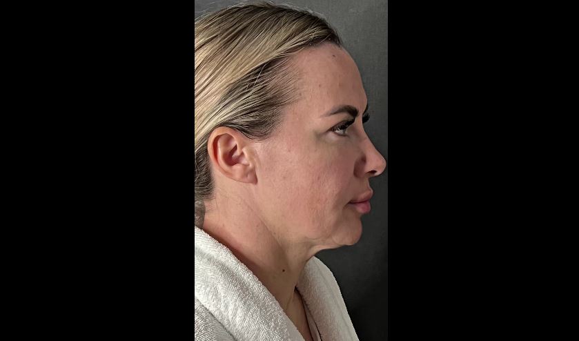 Smas подтяжка лица!