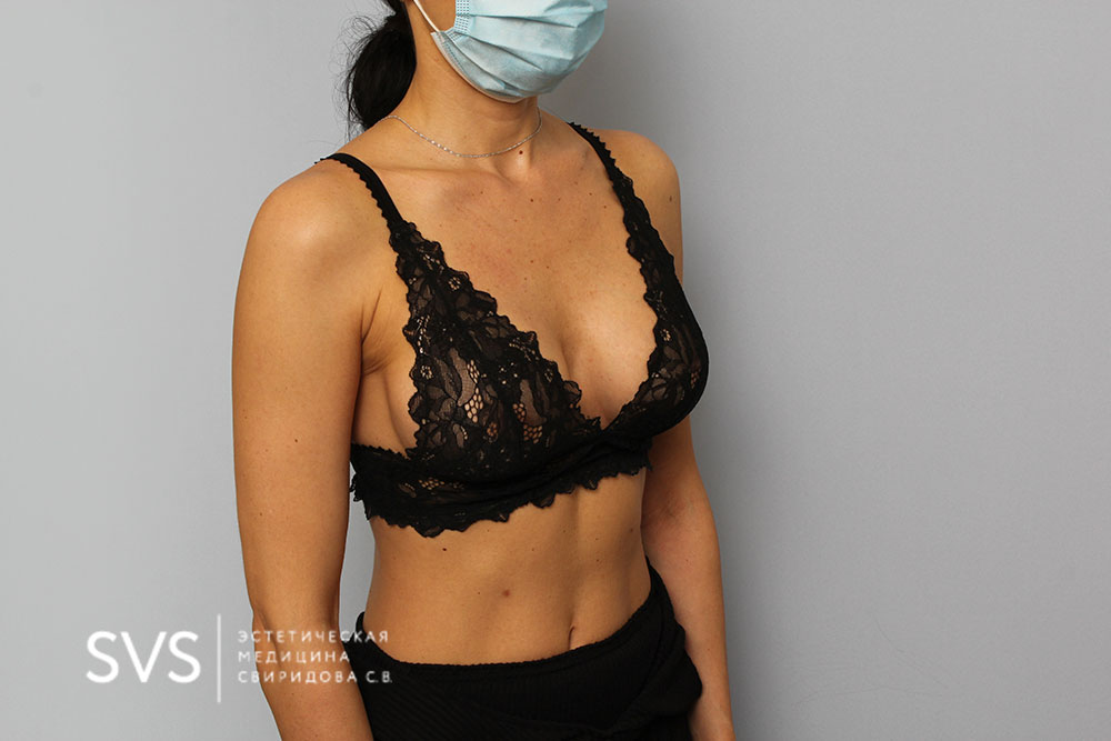 Маммопластика (Пластика груди)