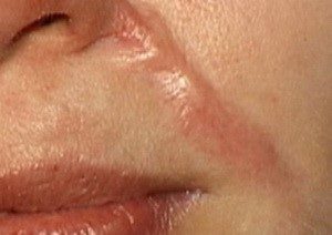 Лечение рубцов и шрамов