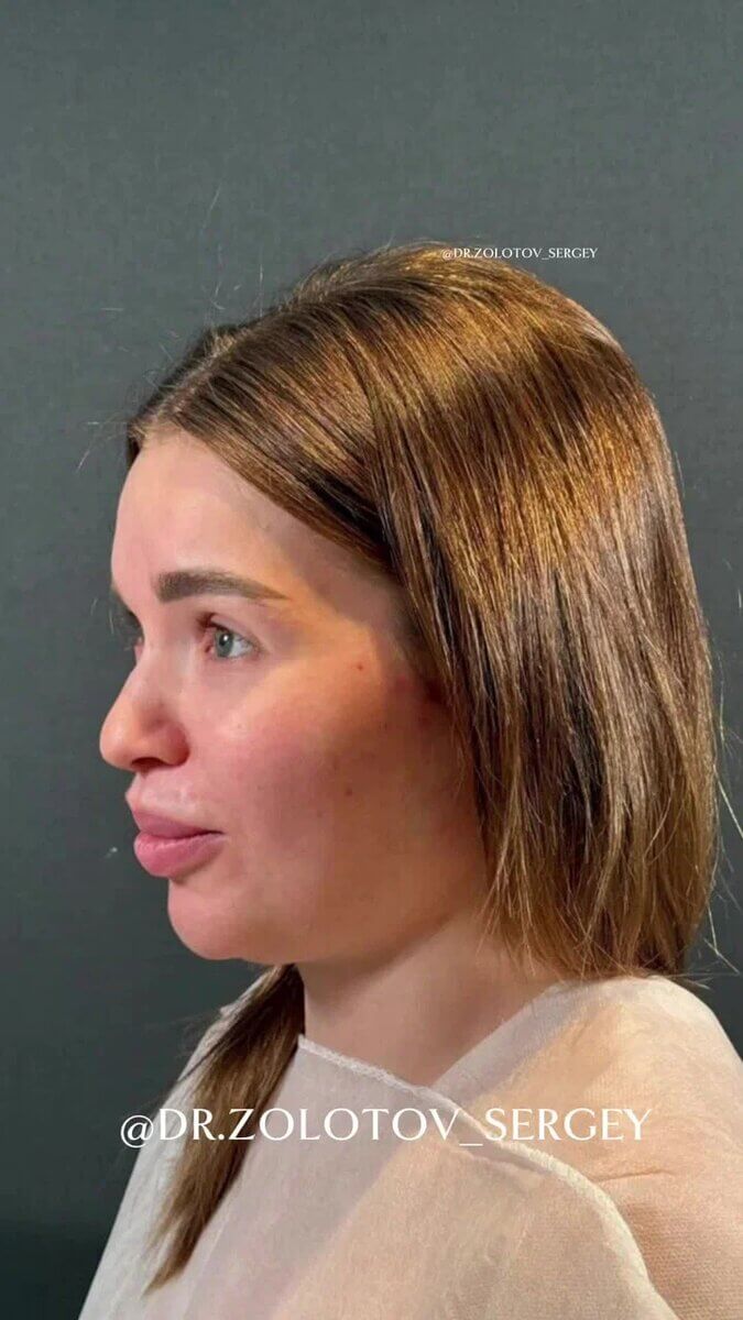 Подтяжка лица без следов от операции.