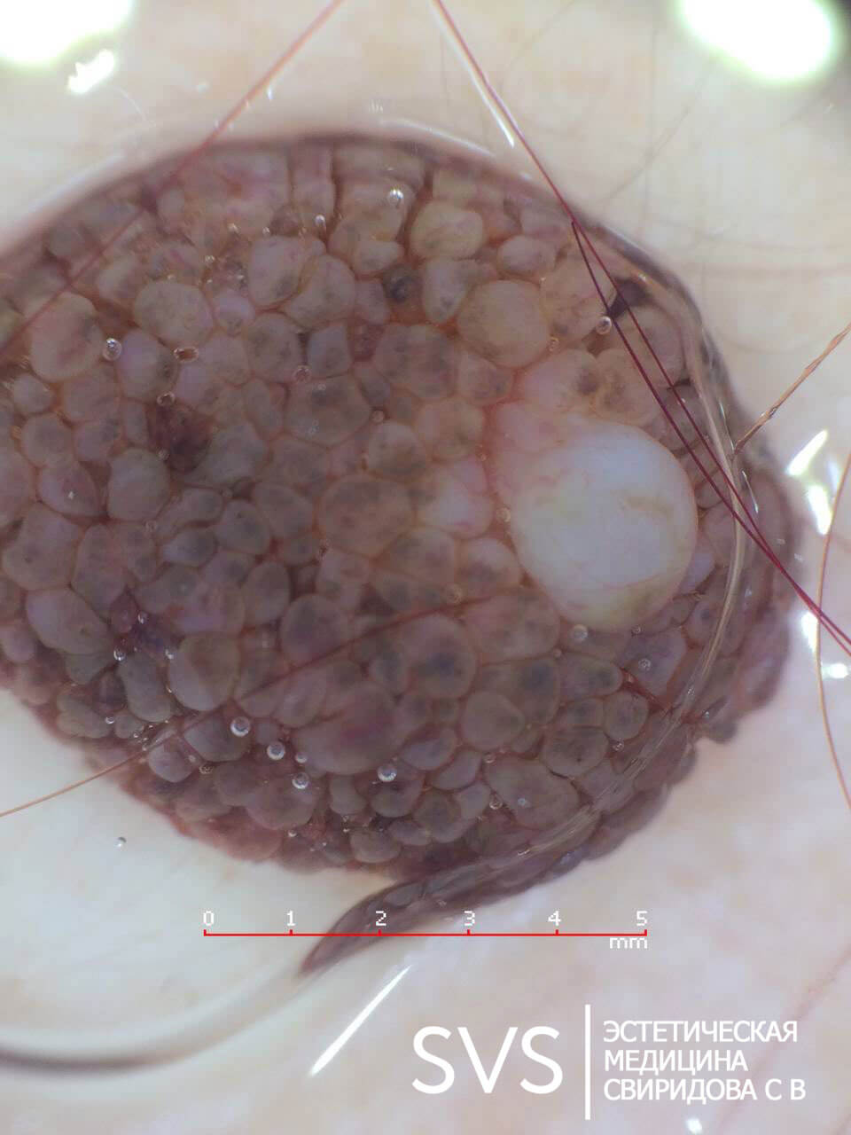 Удаление невуса (родинок)