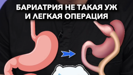 Бариотрическая операция