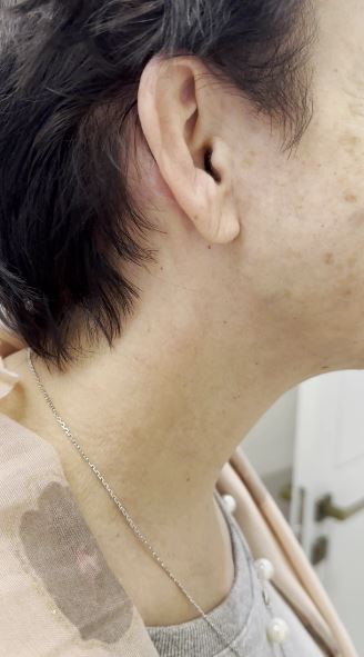 SMAS лифтинг шеи