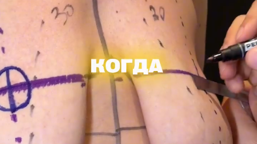 Когда требуется подтяжка груди?