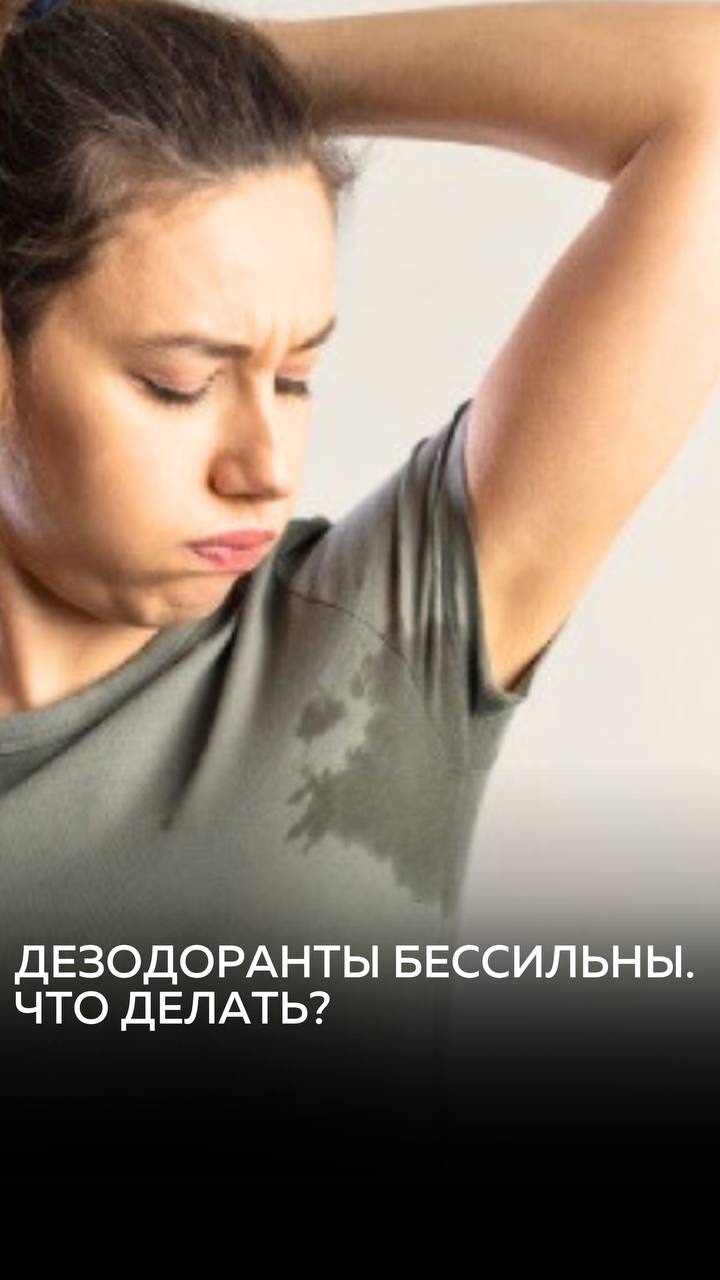 Гипергидроз: когда пот льётся рекой, а ты даже не на пляже