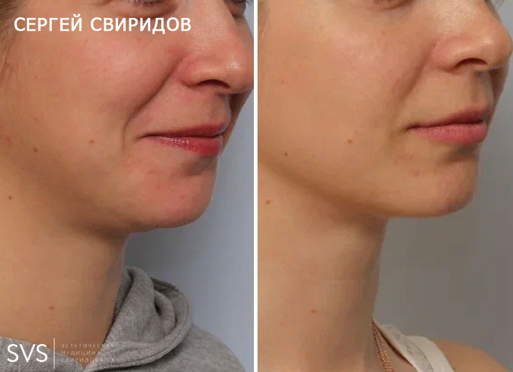Ультразвуковая липосакция подбородка и овала лица