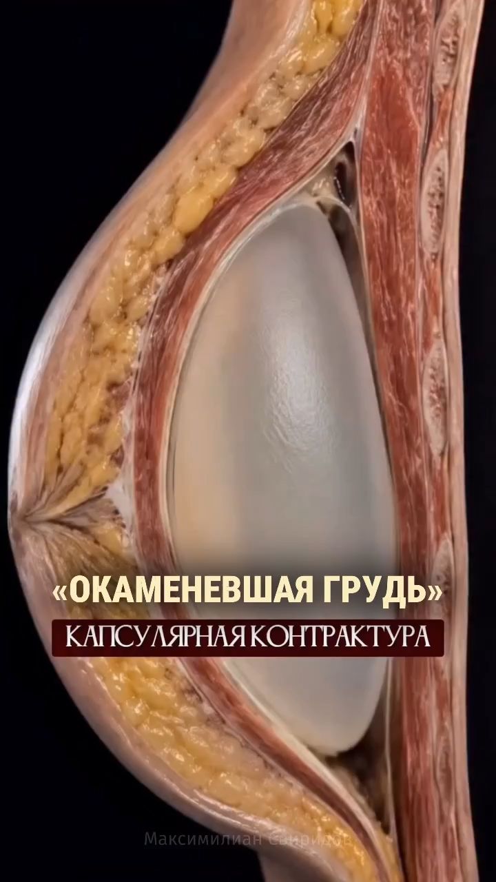 «Окаменевшая» грудь после увеличения — стоит ли этого бояться?