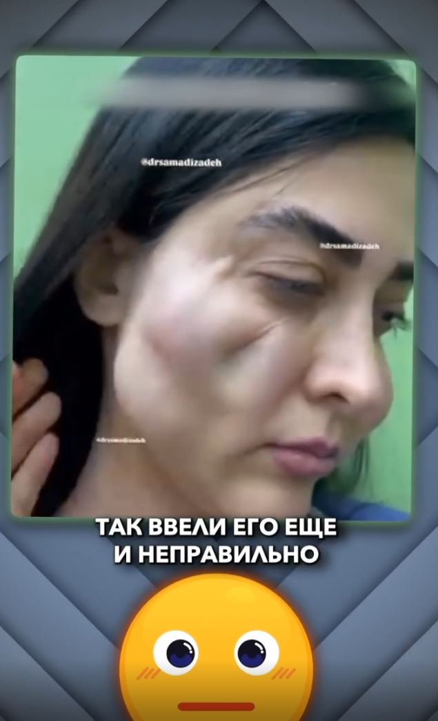 Миграция филлера в скулы — причины, последствия и варианты коррекции