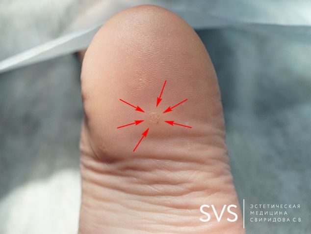 Удаление бородавки