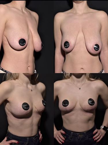 Уже видно результат через 1,5 месяца после подтяжки груди. 