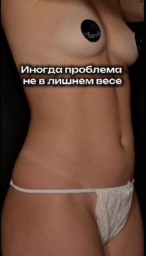 3 недели после липопластики тела. 