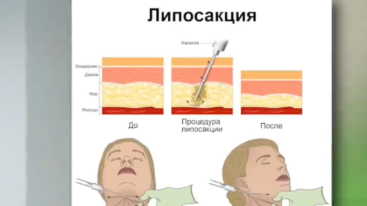 Идеальное время для подтяжки лица: как выбрать оптимальный метод коррекции