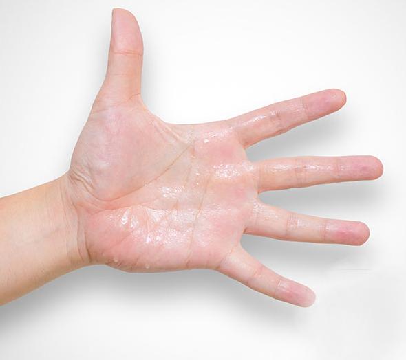 Лечение гипергидроза