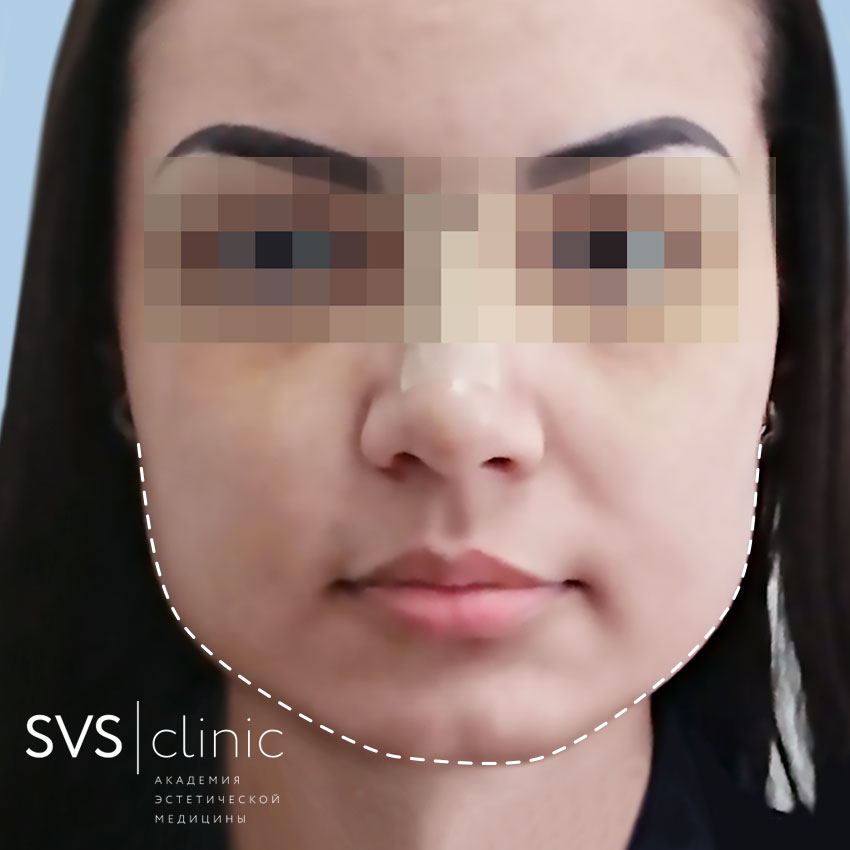 ДО подбородок анфас.jpg