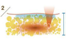 Нагрев жировой ткани круговым ультрозвуком ULFIT