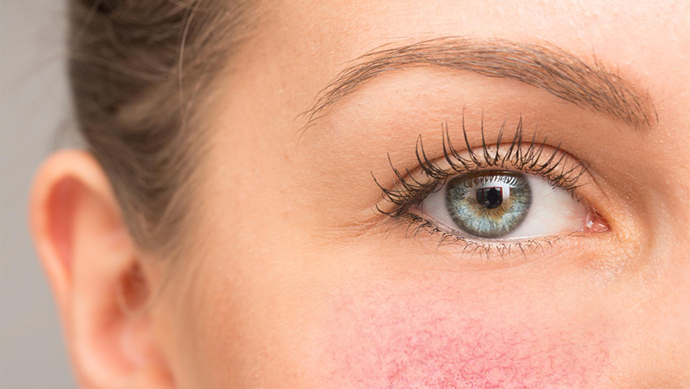 IPL омоложение