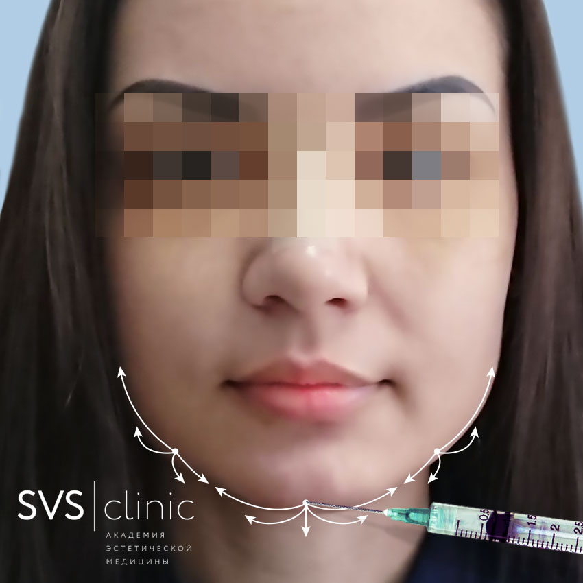 Процедура подбородок анфас.jpg