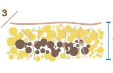 Разрушение жировых клеток