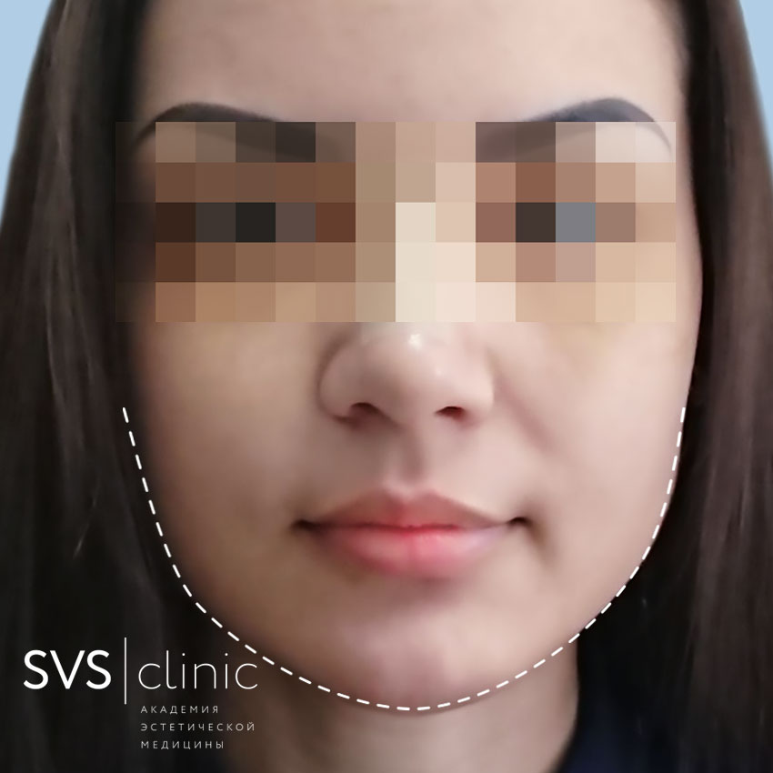 ПОСЛЕ подбородок анфас.jpg