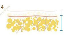 Уменьшение объема жировой ткани