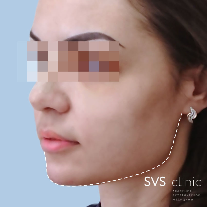 ПОСЛЕ продбородок профиль.jpg