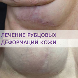 Лечение рубцовых деформаций кожи